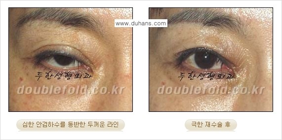 [두한성형외과 경쟁력 쌍꺼풀 재수술, 극한 눈재수술] - [망가진 쌍꺼풀 라인을 교정하는 극한 재수술을  위한 계획] 관련 이미지 8