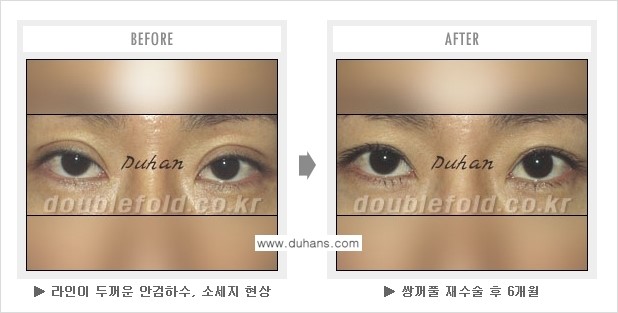 [두한성형외과 경쟁력 "극한 눈(쌍꺼풀) 재수술"] - ["극한 눈(쌍꺼풀) 재수술" 관련 질문과 답변 2.] 관련 이미지 4