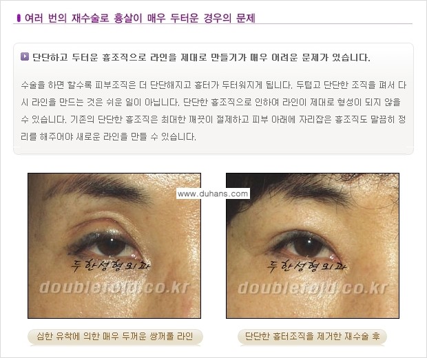 [두한성형외과 극한 재수술, 쌍꺼풀 재수술] - [쌍꺼풀 재수술에서 극복해야 할 극한의 상황과 문제] 관련 이미지 4