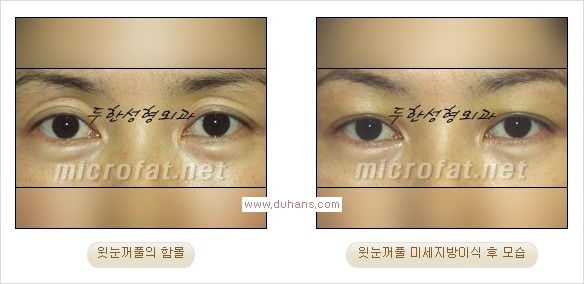 [두한성형외과 경쟁력 쌍꺼풀 재수술, 극한 눈재수술] - [어색한 쌍꺼풀 라인을 교정하는 윗눈꺼풀 미세지방이식] 관련 이미지 23