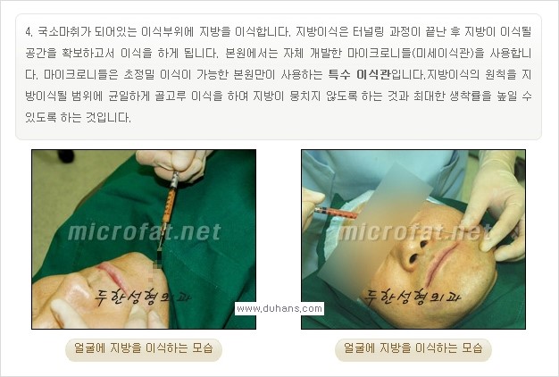 [두한성형외과 경쟁력 미세지방이식] - [타 병원에서 볼살 지방이식 이후 부작용 교정 방법 안내] 관련 이미지 22