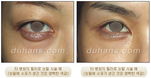 Duhan Plastic Surgery Wrinkle Improvement - Wrinkle Fillers, Juvederm image 15