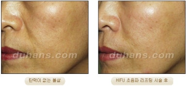 두한성형외과 주름개선 - 주름 HIFU 리프팅 관련 이미지 21
