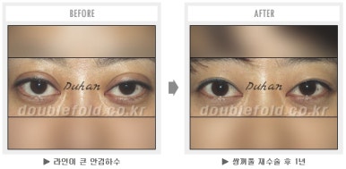 두한성형외과 쌍커풀 재수술 - 짝눈 눈매교정, 가성 안검하수 교정과 뒤밑트임 관련 이미지 41