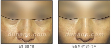 [두한성형외과 주름교정] - [지방이식을 이용한 주름개선] 관련 이미지 16