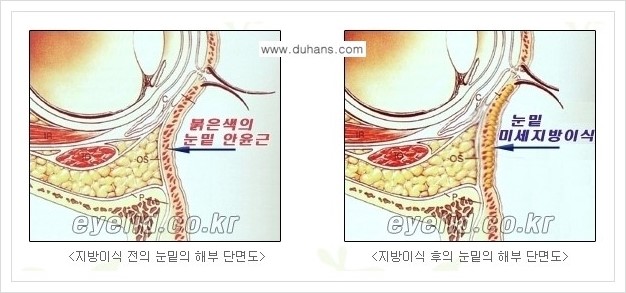 [두한성형외과 경쟁력 눈밑성형] - [다크써클 수술 안내 1.] 관련 이미지 5
