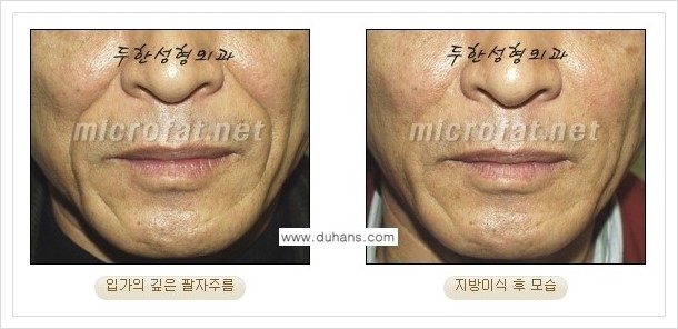 [두한성형외과 경쟁력 지방이식] - [입가주름, 팔자주름 미세지방이식의 안내] 관련 이미지 15