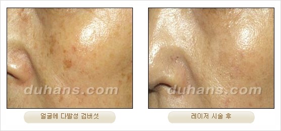 [두한성형외과 경쟁력 안전성형] - [최첨단 장비를 이용한 흉터, 점, 주근깨, 잡티, 문신제거 레이저 시술] 관련 이미지 21