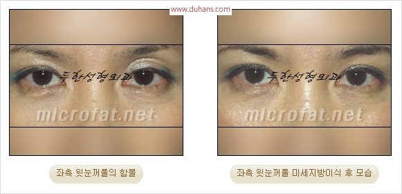 [두한성형외과 경쟁력 눈성형 리더] - [윗눈꺼풀 함몰( #꺼진눈꺼풀) 미세지방이식과 상안검성형]#꺼진눈성형 , #눈위함몰 관련 이미지 34