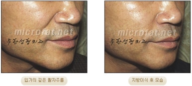 [Duhan Plastic Surgery Face Fat Grafting] - [Reducing Mouth Corners Wrinkles and Nasolabial Folds] image 22