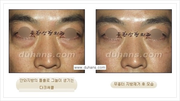 [두한성형외과 경쟁력 안검성형] - [눈밑 지방제거 안내] 관련 이미지 22