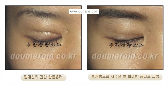 [두한성형외과 경쟁력 쌍꺼풀 재수술] - [쌍꺼풀 절개법 수술 후 쌍꺼풀 흉터선 교정] 관련 이미지 6