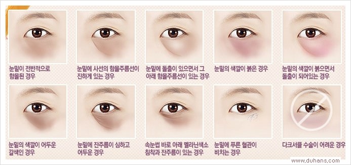 [두한성형외과 경쟁력 눈밑성형] - [눈밑 미세지방이식으로 다크써클 치료] 관련 이미지 1
