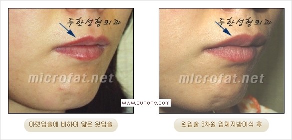 ​​​[두한성형외과 경쟁력 지방이식] - [지방이식을 이용한 입술성형 안내] 관련 이미지 13