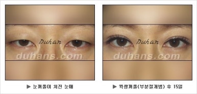Best Place for Double Eyelid Revision Surgery, Duhan Plastic Surgery - Partial Incision Eye Revision Surgery image 8