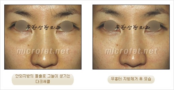 [두한성형외과 쌍커풀수술] - [눈성형 방법에 대한 자주하는 질문과 답변] 관련 이미지 162