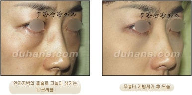 [두한성형외과 지방제거] - [눈두덩이지방제거, 눈밑지방제거] 관련 이미지 48