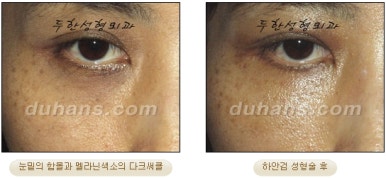 Blepharoplasty, Duhan Plastic Surgery - Upper and Lower Eyelids image 41