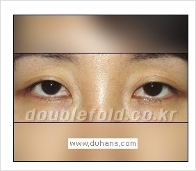 [두한성형외과 경쟁력 쌍꺼풀 재수술] - [Dr. 컬럼 - "재수술의 이상적인 목표"] 관련 이미지 7