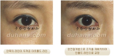 Best Place for Revision Eyelid Surgery, Duhan Plastic Surgery - Lowering Double Eyelid Line image 19