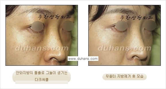 [두한성형외과 젊은 눈매 안검성형] - [눈밑 지방제거의 수술 전후 안내 ①] 관련 이미지 3