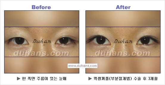 ​[두한성형외과 경쟁력 눈성형] - [자연스러운면서 매력적인 쌍꺼풀 퀵 쌍꺼풀 수술 안내] 관련 이미지 21