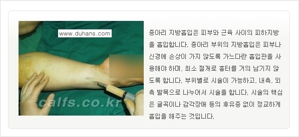 [두한성형외과 매력적인 종아리 만들기!] - [정교한 흡입 - 미세흡입관 지방흡입술 1.] 관련 이미지 5