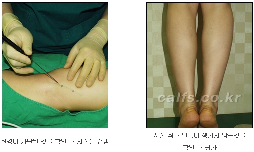 [두한성형외과 종아리퇴축술] - [NO절개! 초음파유도신경차단술] 관련 이미지 16