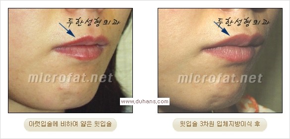 [두한성형외과 경쟁력 미세지방이식] - [입술 3차원 입체지방이식 안내 1.] 관련 이미지 17