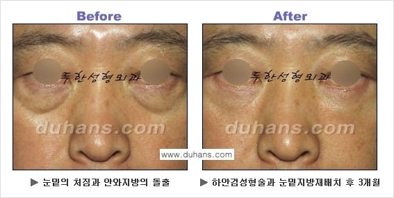 [두한성형외과의 상큼하고 환한 젊은 눈매완성] - [하안검 성형술 ①] 관련 이미지 18