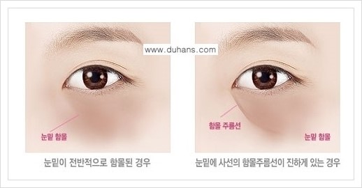 [두한성형외과 경쟁력 다크써클 교정] - [다크써클 5단계로 이뤄지는 핵심 5 STEP SOLUTION 안내 1.] 관련 이미지 2