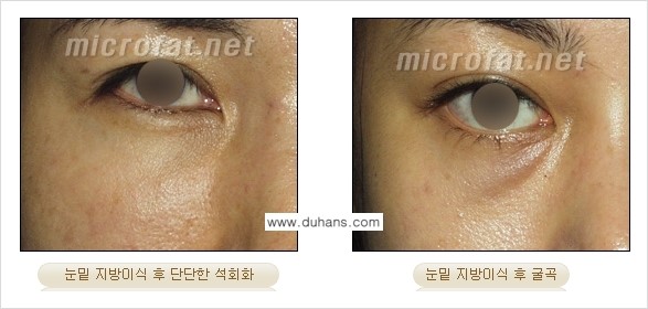 [두한성형외과] - [제대로 된 지방이식으로 부작용에서 탈출하자!] 관련 이미지 4