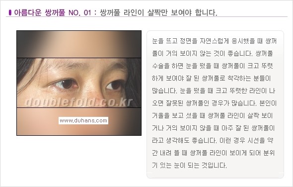 [두한성형외과 경쟁력 쌍꺼풀 재수술, 극한 재수술] - [일반적인 기준의 미운 쌍꺼풀과 아름다운 쌍꺼풀 안내] 관련 이미지 14