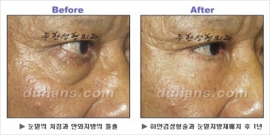 [두한성형외과 안검성형] - [상안검, 하안검] 관련 이미지 60
