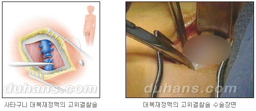[두한성형외과 정맥류] - [정맥류 시술안내] 관련 이미지 8