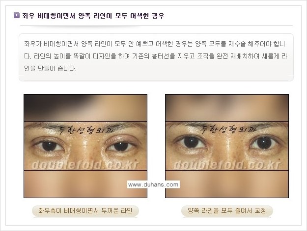 [두한성형외과 경쟁력 쌍꺼풀 재수술] - [짝짝이(비대칭) 쌍꺼풀 라인 교정하는 방법 안내 2.] 관련 이미지 3