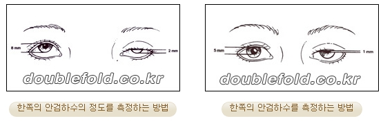 [두한성형외과 경쟁력 눈성형] - [안검하수(졸리운 눈매) 교정 방법 안내] 관련 이미지 10