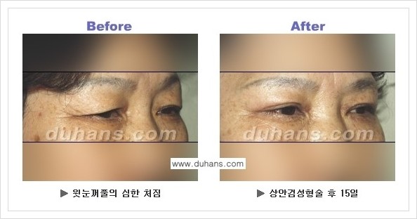 [두한성형외과 경쟁력 눈성형] - [상큼하고 환한 젊은 눈매 상안검성형(윗눈꺼풀 처짐) 안내] 관련 이미지 10