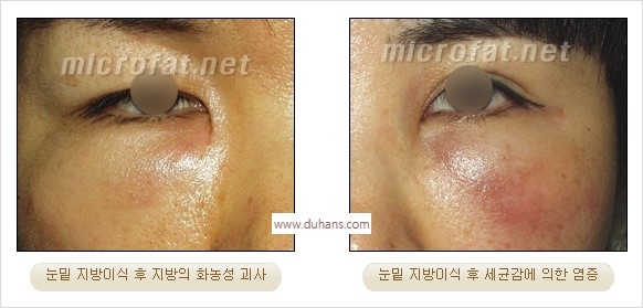 [두한성형외과 경쟁력 미세지방이식] - [타 병원의 지방이식 부작용 교정 - 정교한 마이크로 지방이식, 흡입 안내] 관련 이미지 9
