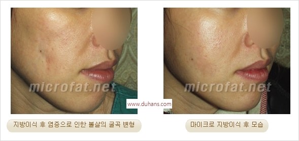[두한성형외과 경쟁력 미세지방이식] - [지방이식 부작용 교정 모습 안내] 관련 이미지 21