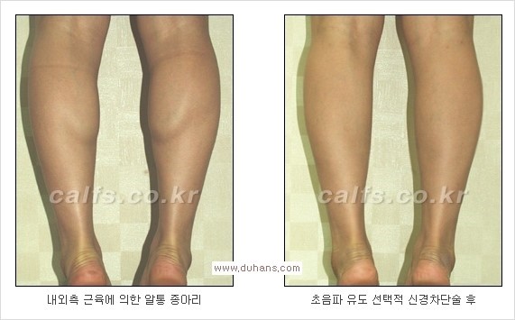 [두한성형외과 경쟁력 종아리성형 리더] -  [종아리 근육 퇴축술 시술방법과 문제점] 관련 이미지 7