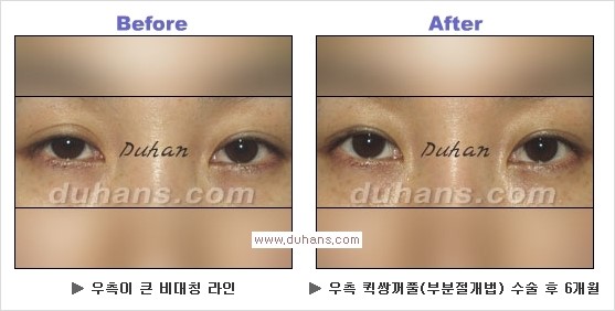 ​[두한성형외과 경쟁력 눈성형] - [자연스러운면서 매력적인 쌍꺼풀 퀵 쌍꺼풀 수술 안내] 관련 이미지 20