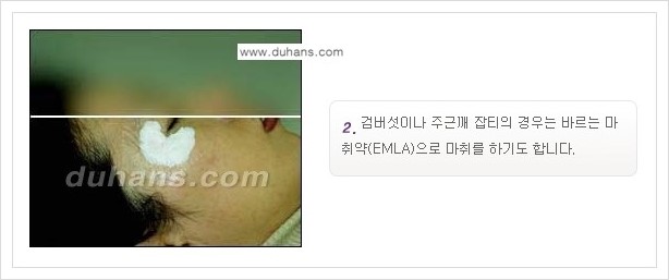 [두한성형외과 경쟁력 레이저시술] - [이산화탄소 점제거 안내] 관련 이미지 4