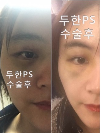 [두한ps]-#눈위,#눈밑,#이마,#관자(#측두부)#지방이식으로 얼굴 볼륨감 살리기 , #꺼진눈꺼풀,#눈꺼풀지방이식 관련 이미지 3