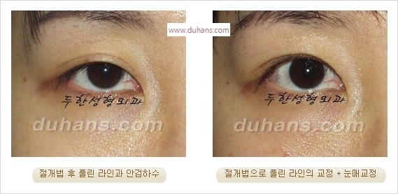 [두한성형외과 경쟁력 눈성형] - [풀려버린 쌍꺼풀 교정 방법] 관련 이미지 4