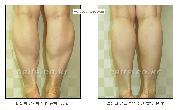 [두한성형외과 Dr. 컬럼] - [종아리 근육퇴축술로 가장 선호하는 비절개 초음파 유도 선택적 신경차단술] 관련 이미지 17
