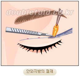 두한성형외과 쌍커풀재수술 - 삼중 쌍커풀 라인 교정 관련 이미지 11