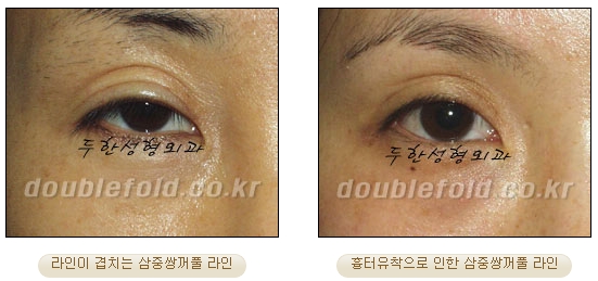 두한성형외과 쌍커풀재수술 - 삼중 쌍커풀 라인 교정 관련 이미지 4