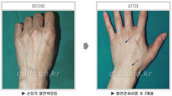 [종아리성형 두한성형외과] - [종아리수술에 대한 자주하는 질문과 답변 모음] 관련 이미지 39