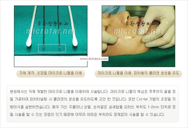 [두한성형외과 경쟁력 눈밑성형] - [꺼진 눈밑, 눈밑 함몰 주름선 눈밑 미세지방이식 안내] 관련 이미지 3